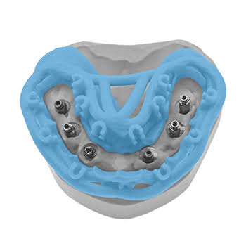 Vue frontale du guide avec implants en place
